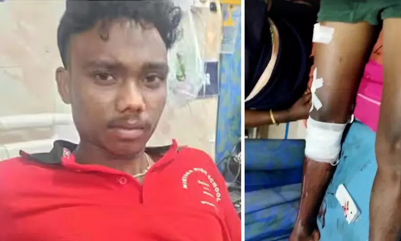 വാൽപ്പാറയിൽ ചീങ്കണ്ണി ആക്രമണത്തിൽ 17കാരന് പരിക്ക്