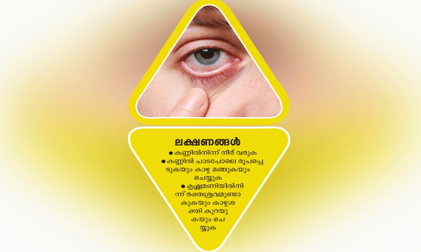 ശ്ര​ദ്ധി​ക്ക​ണം ഡ​യ​ബ​റ്റി​ക് റെ​റ്റി​നോ​പ്പ​തി