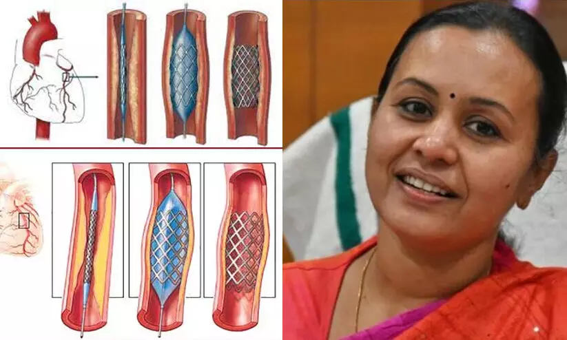 സ്റ്റെന്റിന് കുറവ് വന്നാല് പരിഹരിക്കാന് നടപടിയെന്ന് വീണ ജോര്ജ് സ്റ്റെന്റിന് കുറവ് വന്നാല് പരിഹരിക്കാന് നടപടിയെന്ന് വീണ ജോര്ജ്