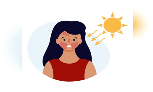 സൂര്യാഘാത ലക്ഷണങ്ങള്‍ കണ്ടാല്‍ വൈദ്യസഹായം തേടണം -ആരോഗ്യവകുപ്പ്