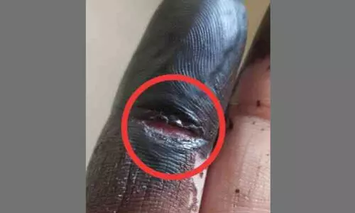 പോളിങ് സ്റ്റേഷനിൽ മഷി പുരട്ടാൻ വിദ്യാർഥിനി; കൈ പഴുപ്പ് ബാധിച്ച് ഗുരുതരാവസ്ഥയിൽ