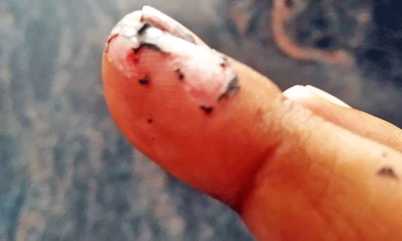finger burnt