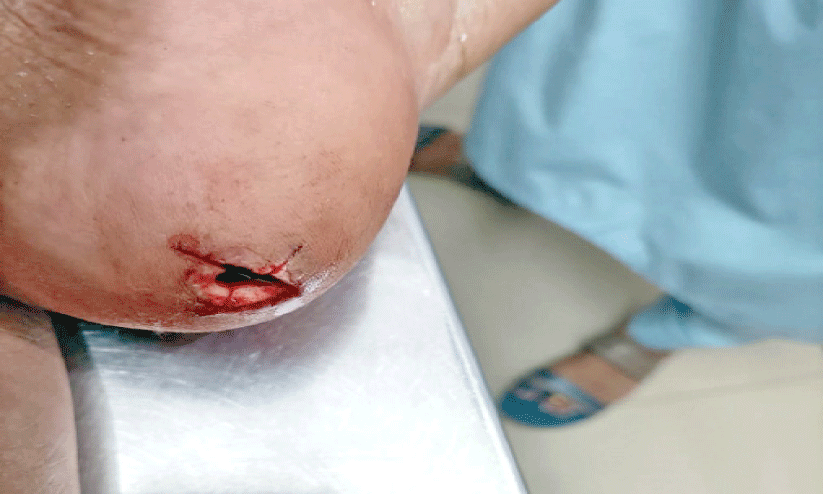 അ​രു​ണി​ന്റെ  കാ​ലി​ലെ മു​റി​വ്