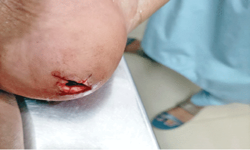 അ​രു​ണി​ന്റെ  കാ​ലി​ലെ മു​റി​വ്