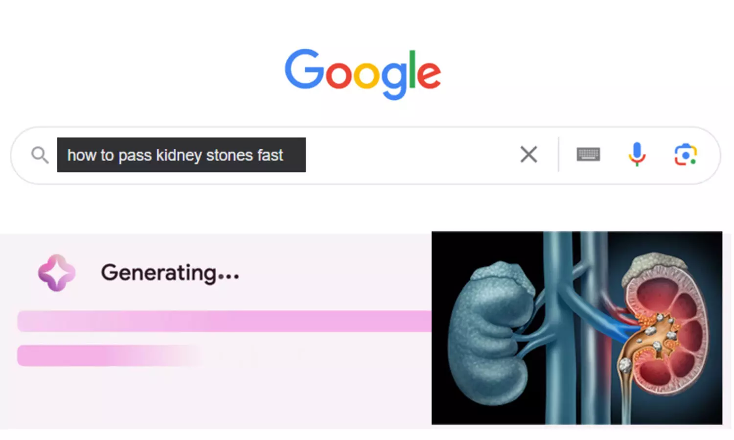 കിഡ്നിയിലെ കല്ല് മാറാൻ 2 ലിറ്റർ മൂത്രം കുടിക്കാൻ ഉപദേശിച്ച് ഗൂഗിൾ എ.ഐ; വിവാദം