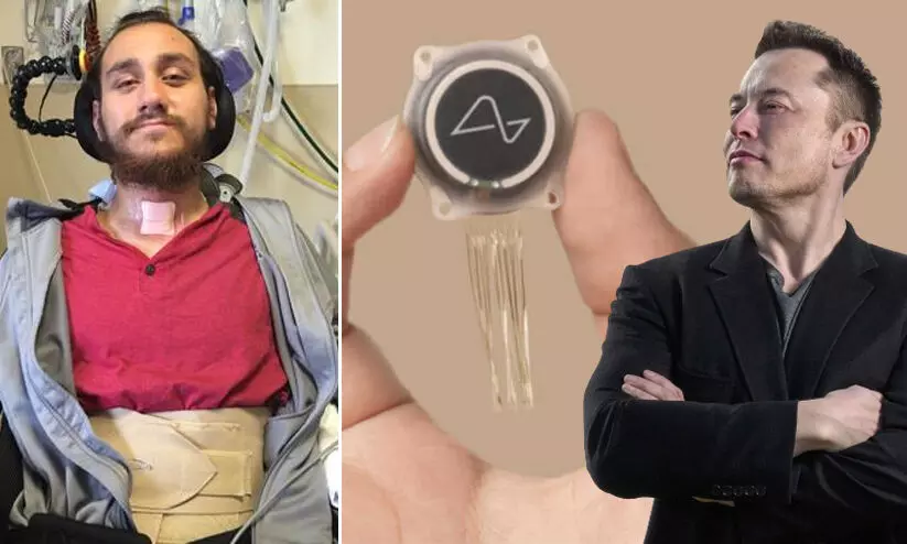 ‘രോഗിയുടെ തലച്ചോറിലേക്ക് ബന്ധിപ്പിച്ച ചിപ്പിന്റെ ത്രെഡുകൾ പണി തന്നു’; ന്യൂറാലിങ്കിന് മെക്കാനിക്കൽ പ്രശ്നങ്ങളെന്ന് കമ്പനി