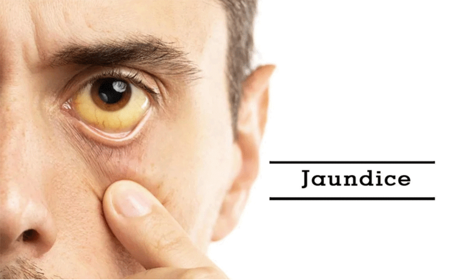 മഞ്ഞപ്പിത്തം: കോട്ടയത്തും ജാഗ്രത നിർദേശം