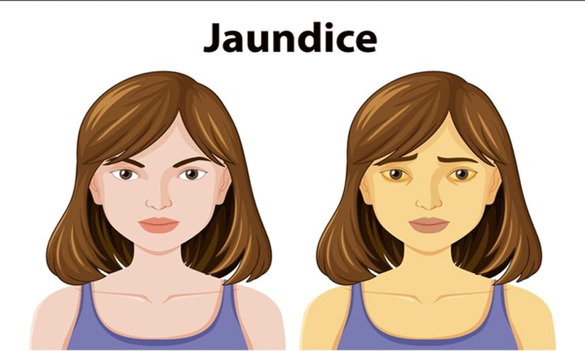 നാ​ടി​നെ ആ​ശ​ങ്ക​യി​ലാ​ക്കി മ​ഞ്ഞ​പ്പി​ത്തം പ​ട​രു​ന്നു