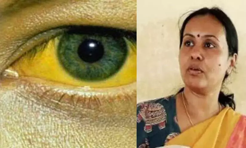 മഞ്ഞപ്പിത്തം മുതിര്‍ന്നവരില്‍ ഗുരുതരമാകാന്‍ സാധ്യതയേറെയെന്ന് വീണ ജോര്‍ജ്