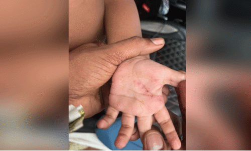 അമിതവൈദ്യുതി പ്രവാഹം: ഒന്നര വയസ്സുകാരന്​ പൊള്ളലേറ്റു