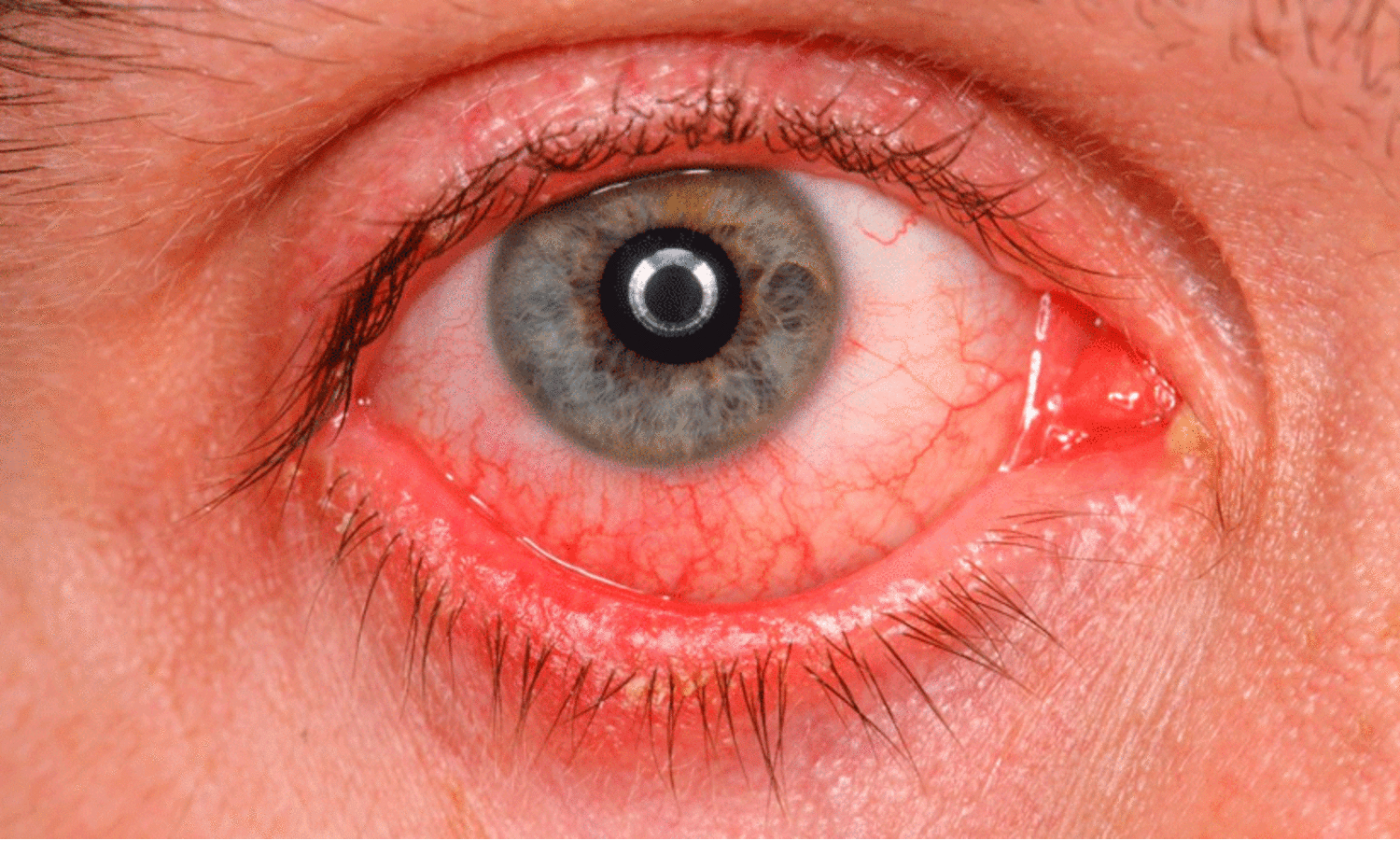 Conjunctivitis,