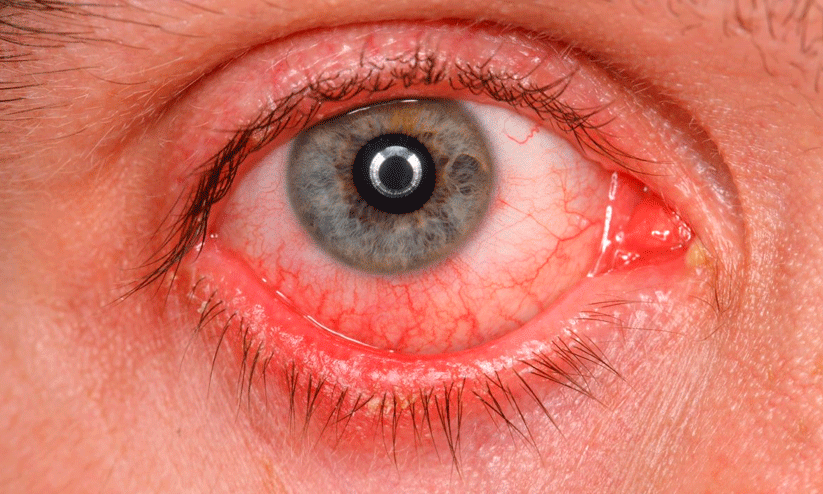 Conjunctivitis,