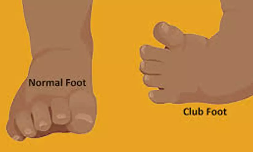 കു​ഞ്ഞു​ങ്ങ​ളി​ലെ ക്ലബ് ഫൂട്ട് വൈ​ക​ല്യ​ത്തി​ന് സൗ​ജ​ന്യ ചി​കി​ത്സ;  അ​റി​യാ​തെ ജ​നം