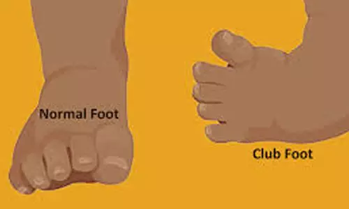 കുഞ്ഞുങ്ങളിലെ ക്ലബ് ഫൂട്ട് വൈകല്യത്തിന് സൗജന്യ ചികിത്സ; അറിയാതെ ജനം കുഞ്ഞുങ്ങളിലെ ക്ലബ് ഫൂട്ട് വൈകല്യത്തിന് സൗജന്യ ചികിത്സ; അറിയാതെ ജനം