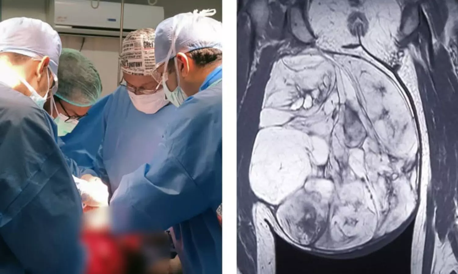 10 കിലോ ഭാരമുള്ള മുഴ കാരണം നടക്കാന്‍ കഴിയാതെ വന്ന 61കാരിക്ക് ആശ്വാസമേകി തൃശൂര്‍ മെഡിക്കല്‍ കോളജ്