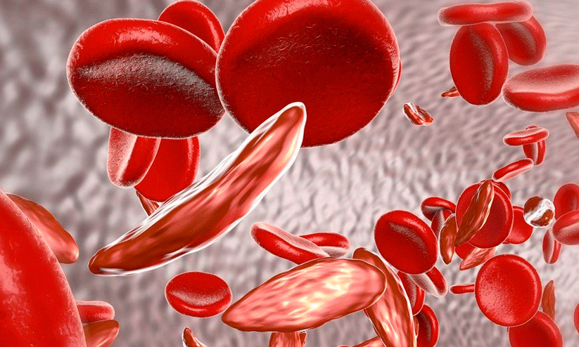 World Sickle Cell Day World Sickle Cell Day