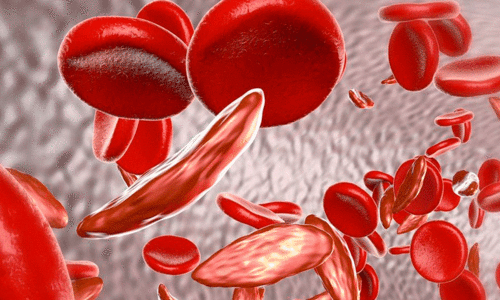 World Sickle Cell Day