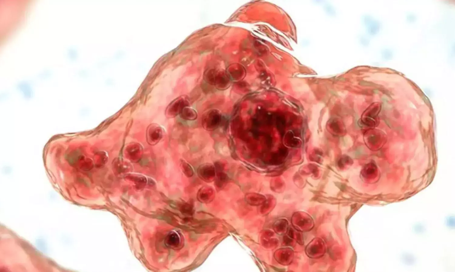 ചികിത്സയിലുള്ള വിദ്യാർഥിക്ക് അമീബിക് മസ്തിഷ്‍ക ജ്വരം സ്ഥിരീകരിച്ചു