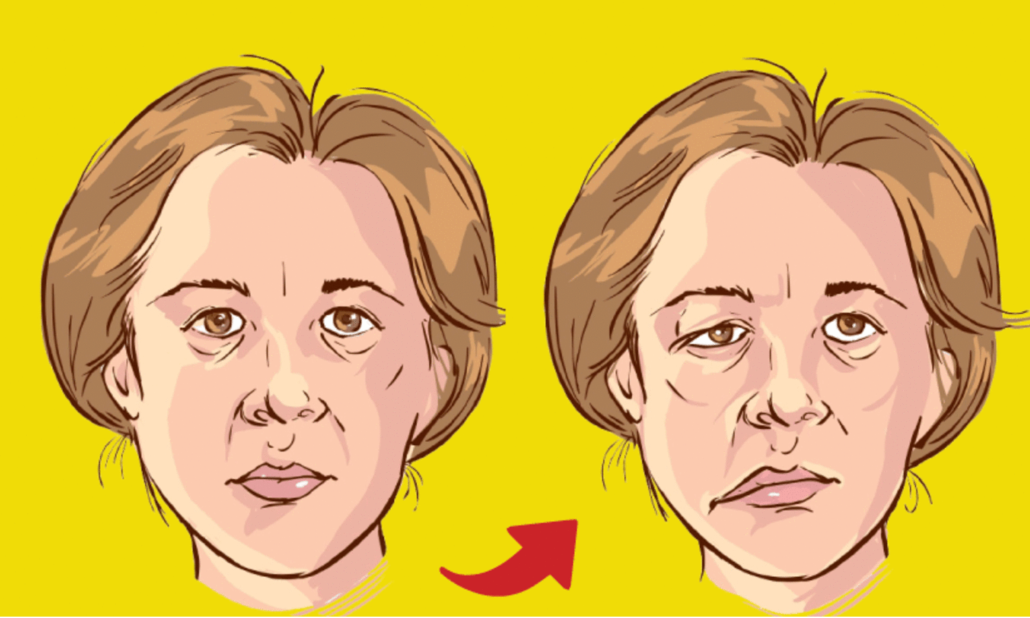 ബെ​ല്‍സ് പാ​ള്‍സി ശ്ര​ദ്ധ​വേ​ണം