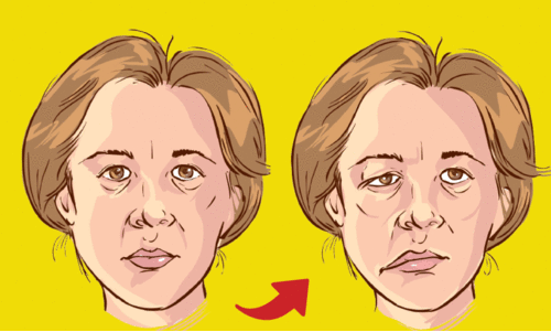 ബെ​ല്‍സ് പാ​ള്‍സി ശ്ര​ദ്ധ​വേ​ണം