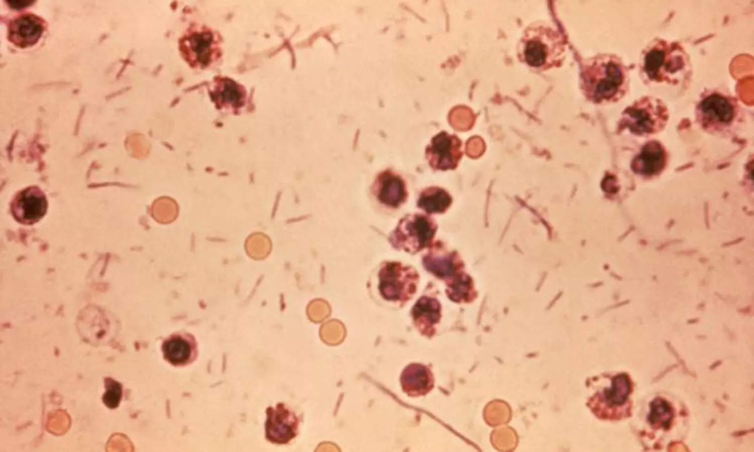 മലപ്പുറത്ത് നാലു കുട്ടികള്‍ക്ക് ഷിഗെല്ല സ്ഥിരീകരിച്ചു