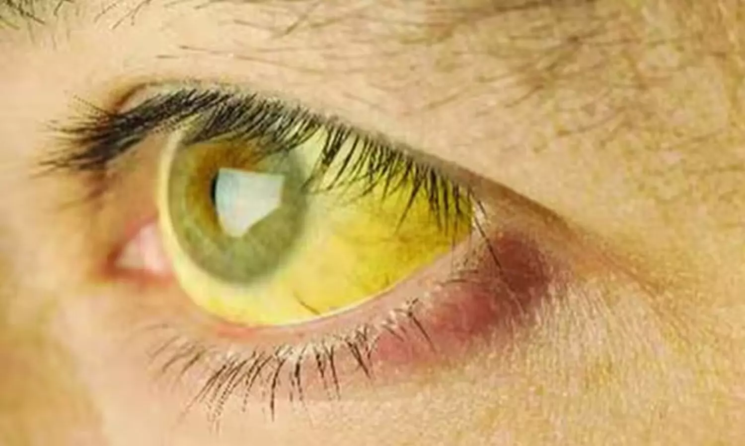 59 വിദ്യാർഥികൾക്ക് മഞ്ഞപ്പിത്തം; സ്‌കൂള്‍ അടച്ചു