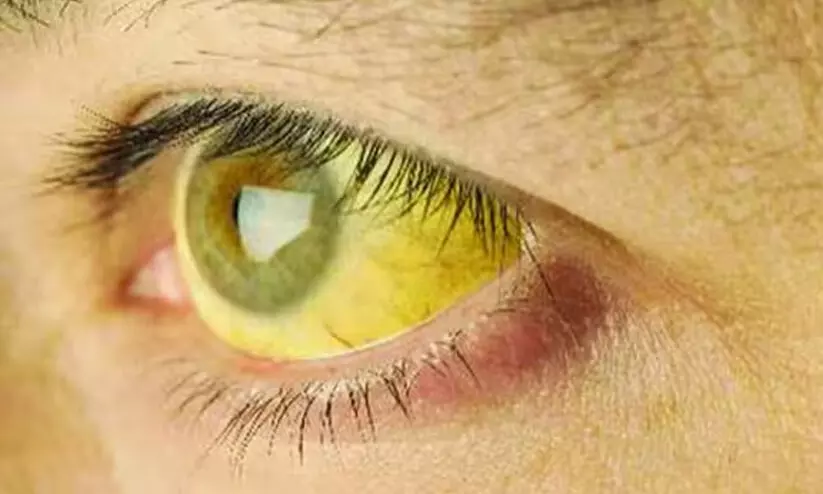 59 വിദ്യാർഥികൾക്ക് മഞ്ഞപ്പിത്തം; സ്‌കൂള്‍ അടച്ചു