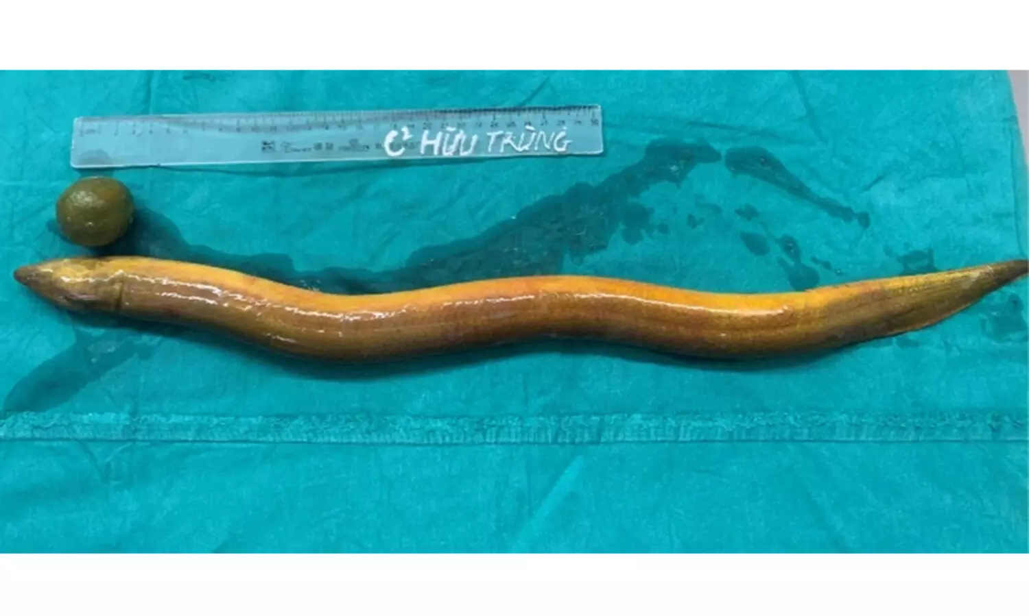 32കാരന്‍റെ മലദ്വാരത്തിലൂടെ കയറിയത് 65 സെ.മീ നീളമുള്ള ആരൽ