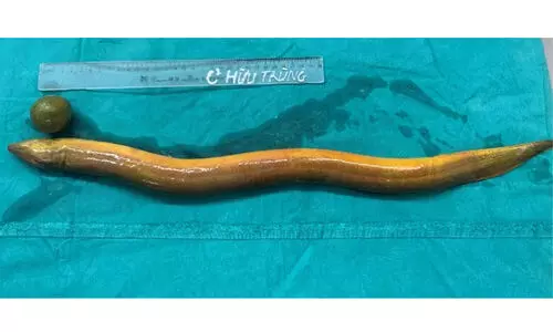 32കാരന്‍റെ മലദ്വാരത്തിലൂടെ കയറിയത് 65 സെ.മീ നീളമുള്ള ആരൽ