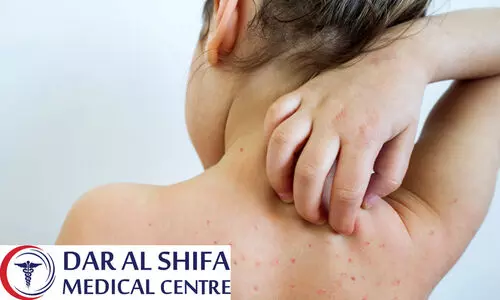 heat rash, Diseases