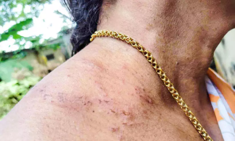 വലതുതോളിൽ മുറിവേറ്റ വിശ്വലക്ഷ്മി വലതുതോളിൽ മുറിവേറ്റ വിശ്വലക്ഷ്മി