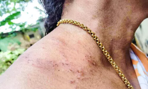 വ​ല​തു​തോ​ളി​ൽ മു​റി​വേ​റ്റ വി​ശ്വ​ല​ക്ഷ്മി