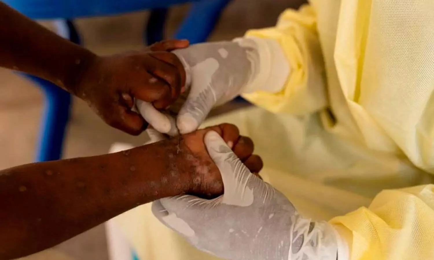 ഭീതി പരത്തി എംപോക്സ്; 116 രാജ്യങ്ങളിൽ പടർന്നു, ആഗോള ആരോഗ്യ അടിയന്തരാവസ്ഥ പ്രഖ്യാപിച്ചു