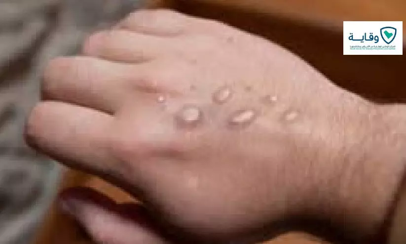 monkey pox monkey pox