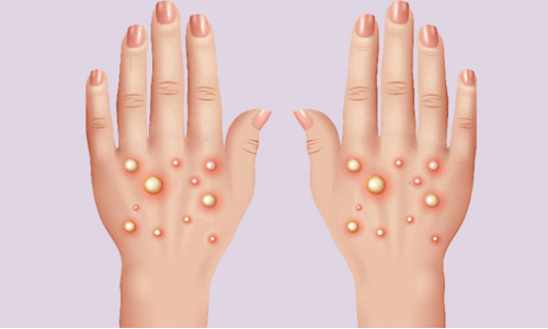 എംപോക്‌സ്: ആരോഗ്യ വകുപ്പിന്റെ നിർദേശം പാലിക്കണം