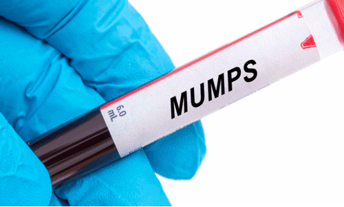 mumps