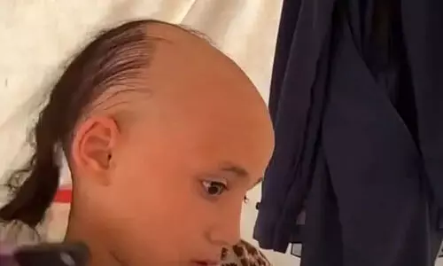 ബോംബ് ആക്രമണം നേരിട്ടു കണ്ടതിന്റെ ആഘാതം: മുടി കൊഴിഞ്ഞ് ഫലസ്തീൻ ബാലിക