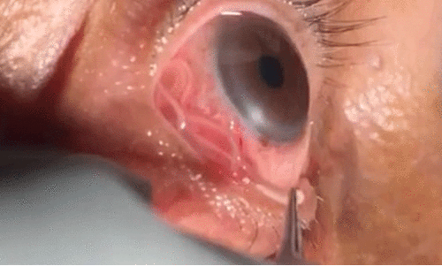 ക​ണ്ണി​ൽ​നി​ന്ന് 10 സെ.​മീ​റ്റ​ർ നീ​ള​മു​ള്ള വി​ര​ക​ളെ നീ​ക്കം ചെ​യ്തു