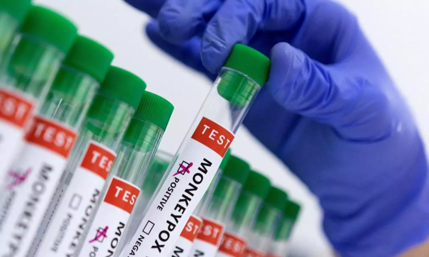 കണ്ണൂരിലും എം പോക്‌സ്? വിദേശത്ത് നിന്നെത്തിയ 32കാരിക്ക് രോഗലക്ഷണങ്ങള്‍