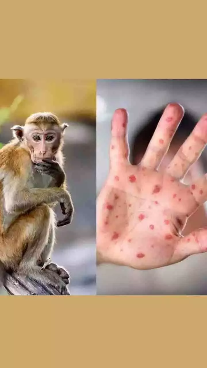 എംപോക്സ് എന്താണ്? വാനരവസൂരിയെ കുറിച്ച് അറിയേണ്ടതെല്ലാം