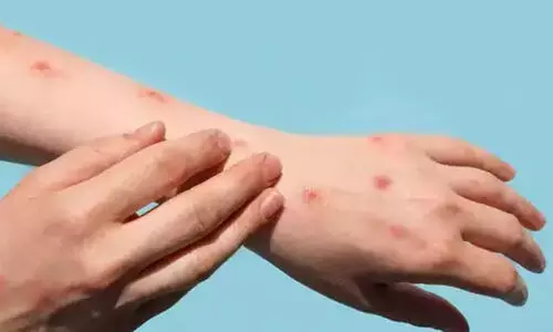 എം പോക്സ്: യുവാവിന്റെ നില തൃപ്തികരം