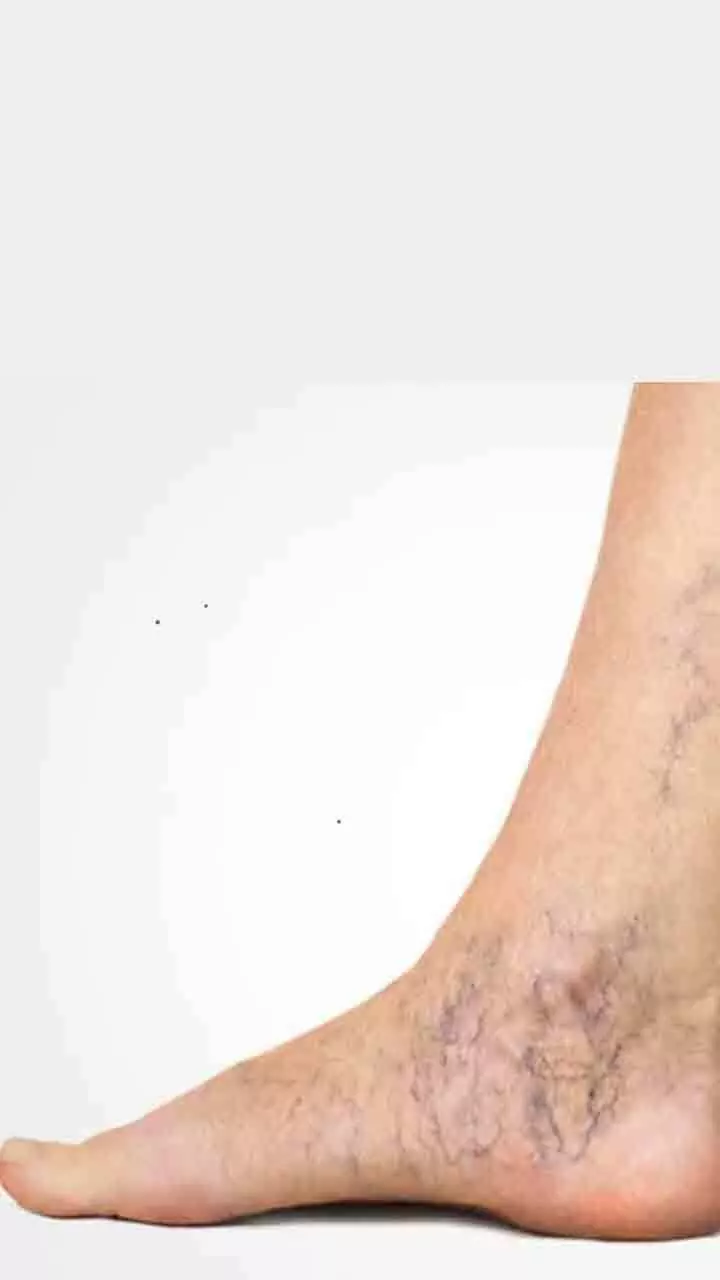 തൊലിപ്പുറത്തെ നിറ വ്യത്യാസം വേരിക്കോസ് വെയിനിന്‍റെ തുടക്കമോ?