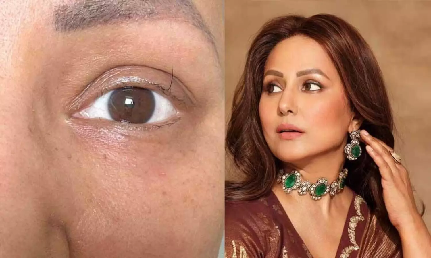 Hina Khan Shares Photo Of Last Eyelash As She Nears Final Cycle Of Chemotherapy, Pens Emotional Note