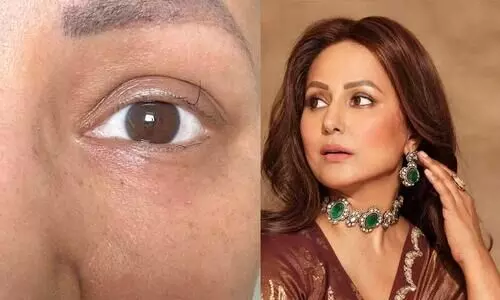 Hina Khan Shares Photo Of Last Eyelash As She Nears Final Cycle Of Chemotherapy, Pens Emotional Note