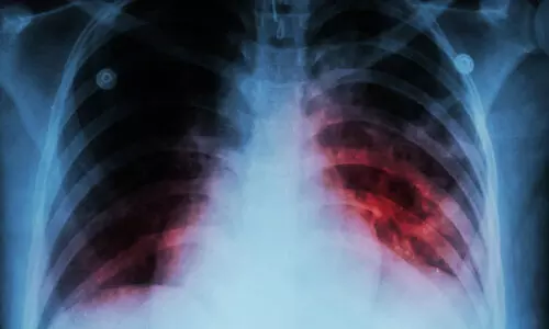 ജി​ല്ല​യി​ല്‍ 2157 ക്ഷ​യ​രോ​ഗികൾ