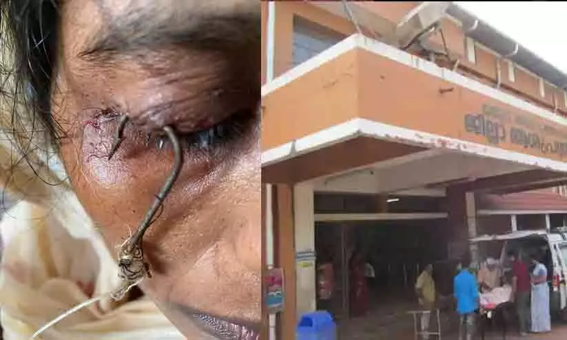 യുവതിയുടെ കൺപോളയിൽ തുളച്ചു കയറിയ ചൂണ്ട നീക്കം ചെയ്തു യുവതിയുടെ കൺപോളയിൽ തുളച്ചു കയറിയ ചൂണ്ട നീക്കം ചെയ്തു