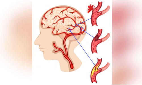 മ​സ്‌​തി​ഷ്കാ​ഘാ​തം ശ്ര​ദ്ധ​വേ​ണം