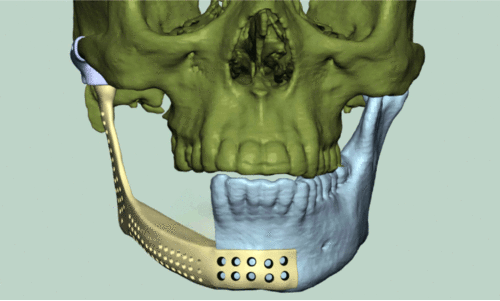 ഗ​വ. മെ​ഡി​ക്ക​ൽ കോ​ള​ജി​ൽ ത്രീ​ഡി പ്രി​ന്റി​ങ് ചി​കി​ത്സ ഫ​ല​പ്ര​ദം