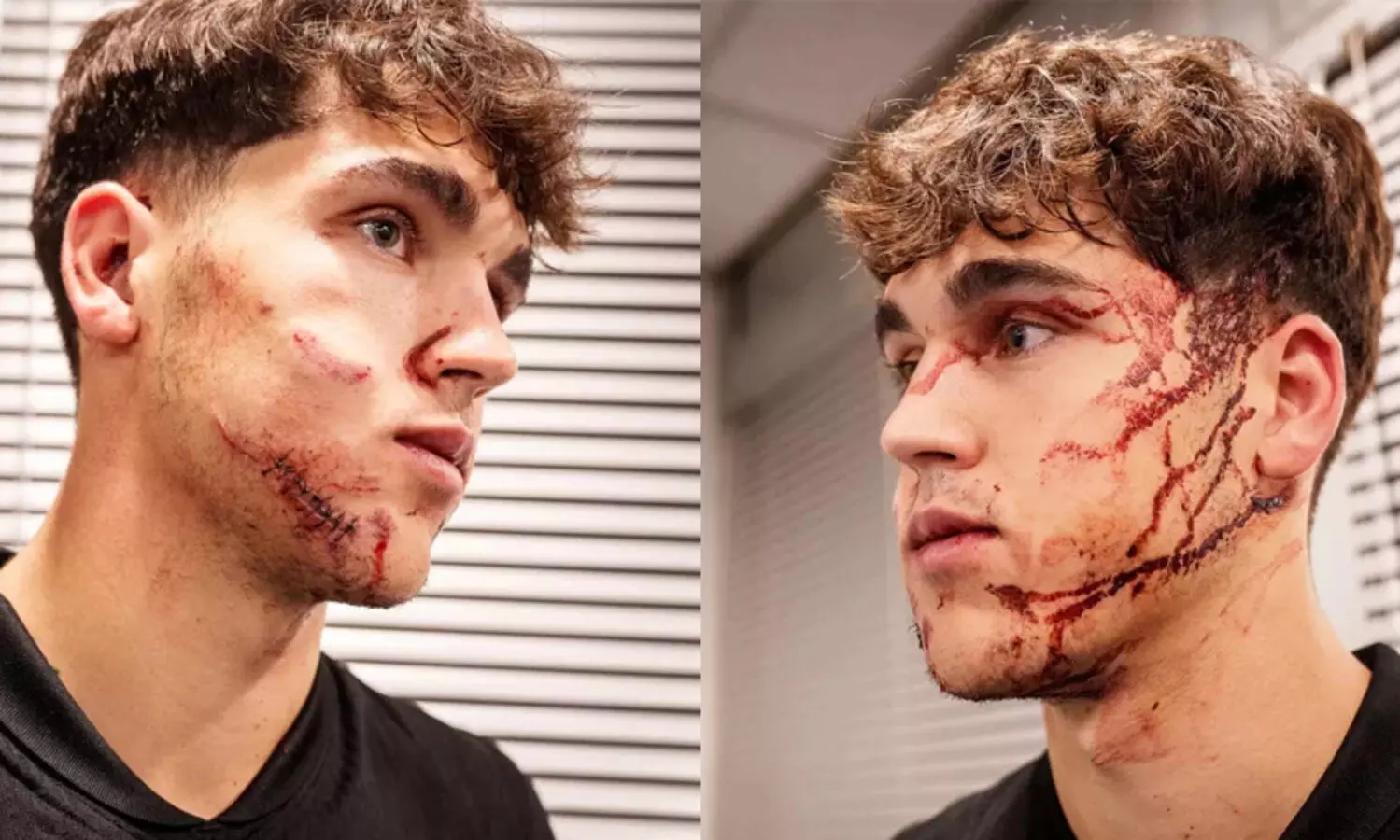 ബൂട്ടടികൊണ്ട് വീണു, ബാഴ്സ താരത്തിന്റെ പരിക്ക് ഗുരുതരം; മുഖത്ത് 10 തുന്നലുകൾ