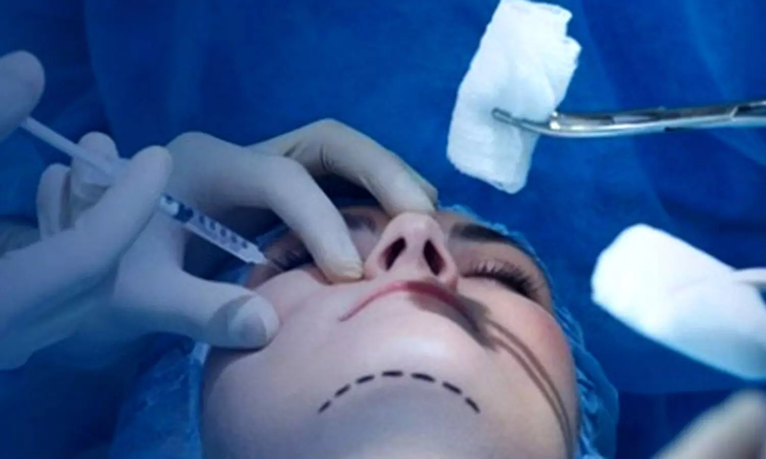 ഒരു ദിവസം ആറ് സൗന്ദര്യവർദ്ധക ശസ്ത്രക്രിയകൾ; ചൈനയിൽ യുവതിക്ക് ദാരുണാന്ത്യം